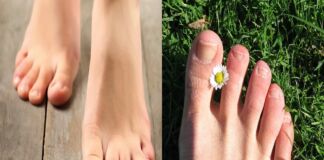 Ingrown toenails – কুনি নখ