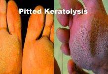 pitted-keratolysis-home-remedy