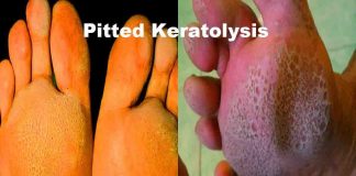 pitted-keratolysis-home-remedy