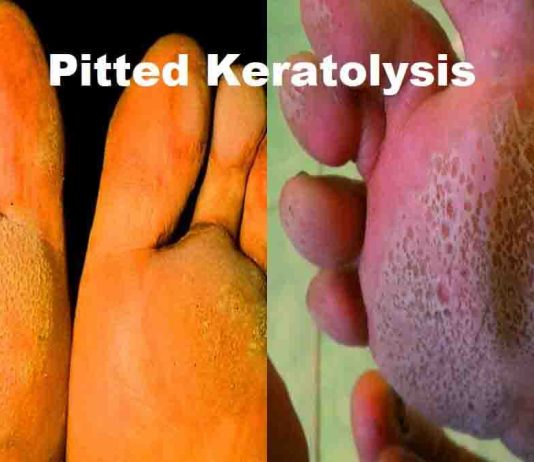 pitted-keratolysis-home-remedy