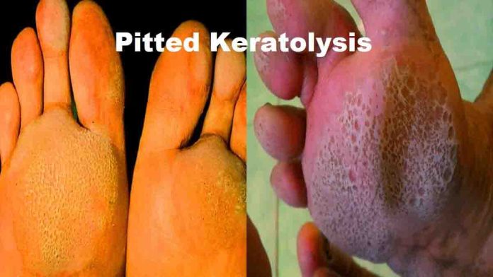 pitted-keratolysis-home-remedy