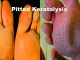 pitted-keratolysis-home-remedy